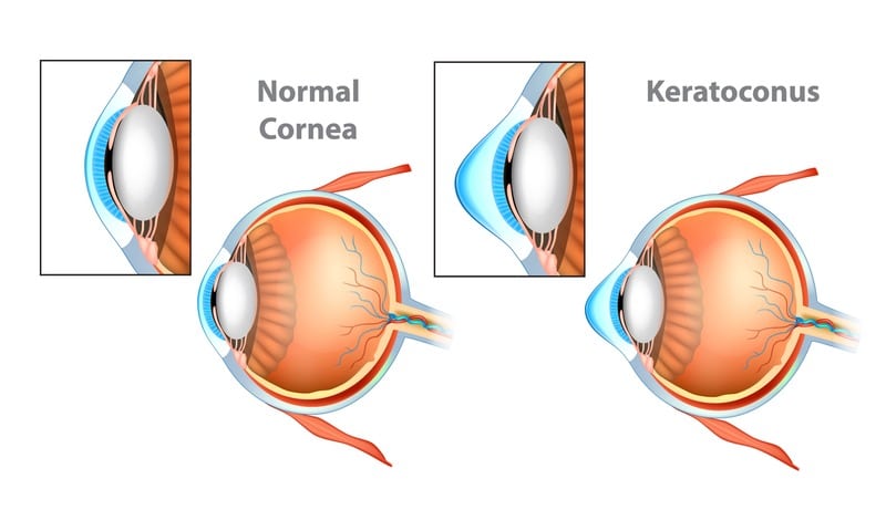 Cheratocono differenza con cornea normale