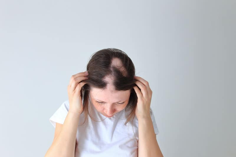 alopecia femminile